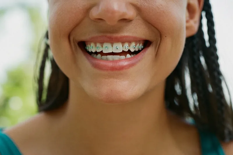 Young woman smiling with tooth-colored ceramic braces