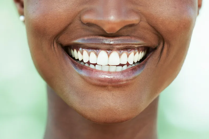 Close-up of a bright, radiant white smile